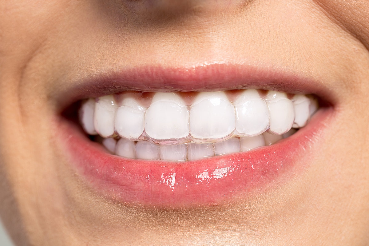 Invisalign Deutschland: Moderne Techniken zur Zahnstellungskorrektur
