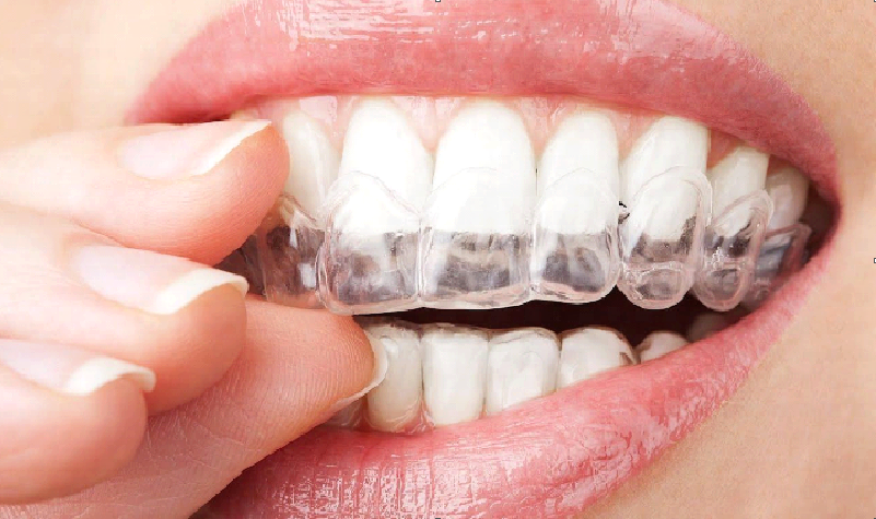 Invisalign Deutschland: Moderne Techniken zur Zahnstellungskorrektur