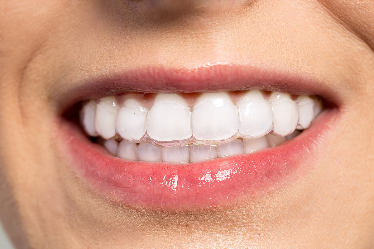 Invisalign Deutschland: Moderne Techniken zur Zahnstellungskorrektur